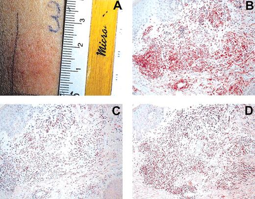 Figure 1. Induction of tumor-lysate-specific DTH after DC vaccination. (A) Positive DTH reaction (25 mm) in patient 1 after intradermal injection of tumor lysate. Immunohistochemical investigations were performed using mAbs for CD4 (B), CD8 (C), and TIA (D). Note heavy infiltration of DTH challenge site. Sections were stained using the APAAP technique and counterstained with hematoxylin. Original magnification, × 200 (B-D).