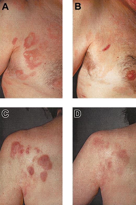 Figure 3. Regression of CTCL lesions after tumor-lysate-pulsed DC vaccination. Regression of infiltrated plaques of patient 8 (A, before therapy), leaving an area of residual erythema without palpable infiltration (B, after therapy). Regression of tumors, plaques, and patches in patient 1 (C, before therapy; D, after therapy).