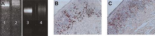 Figure 6. Induction of molecular remission in the presence of infiltration with CD8+ cytotoxic killer cells. (A) TCR-γ chain PCR DGGE of CTCL patient 1 demonstrating a Vγ 1-8 band before treatment (lane 2), positive control MyLa cell line (lanes 1 and 3). Disappearance of tumor-specific clone after vaccination in residual erythematous lesion (lane 4). Immunohistologic staining of regressive CTCL lesion demonstrates infiltration of CD8+ (B) and TIA+ (C) T cells at the dermo-epidermal junction. Sections were stained using the APAAP technique and counterstained with hematoxylin. Original magnifications, × 400 (B) and × 200 (C).