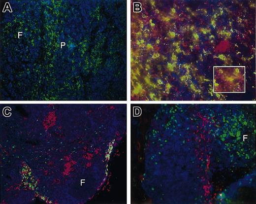 Figure 7. Localization of rhesus DC subsets within normal and Flt3L-treated rhesus monkey lymph nodes. (A) Normal lymph node: germinal center CD11c+ myeloid DCs (green) are visible as CD11c+ cells with dendritic morphology within follicular (F) and parafollicular (P) regions (original magnification × 200). (B) p55 (Fascin)-stained DC (green) colocalizing with CD123-biotin (red) to indicate preplasmacytoid DCs within normal lymph node (orange/yellow; inset magnification × 600). (C) Cells expressing CD123 in Flt3L-mobilized rhesus monkeys tended to occur in aggregates (red), whereas CD11c+ cells (green) were visible as isolated cells (original magnification × 100). (D) Ki-67 staining of lymph node from an Flt3L-treated rhesus monkey, showing CD123+ cells (red) in clumps distinct from Ki-67-positive cells (green), predominantly within the follicle (F) (original magnification × 200).