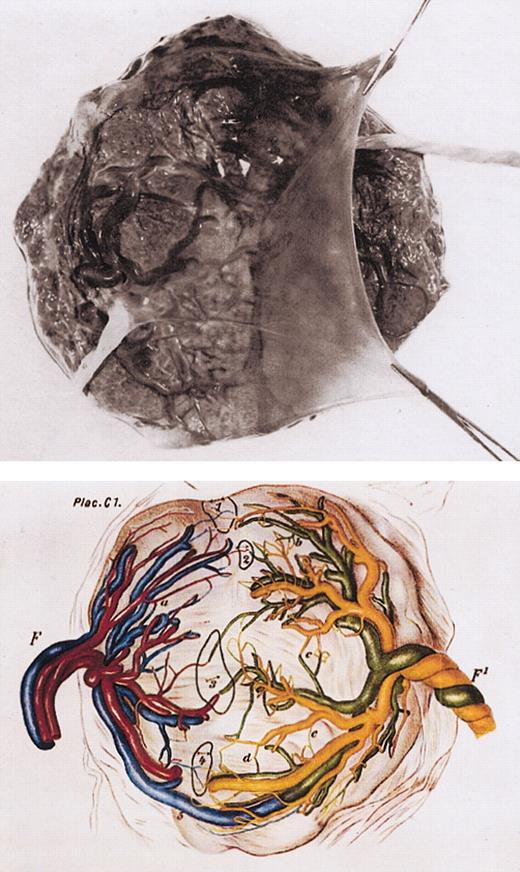 Figure 4. Monochorionic placenta in monozygotic twinning. Top panel: photograph of single, monochorionic placenta with dividing amnion tissue and 2 umbilical cords. Bottom panel: diagrammatic regeneration of monochorionic twin placenta with vascular anastomoses (labeled 1-5). F and F1 indicate umbilical cord of 2 twins. Taken from Strong and Corney.39