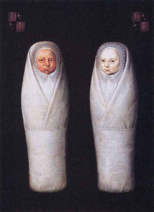 Figure 5. Artistic representation of newborn infant twins with probable twin-twin transfusion syndrome. Painting from 1617 titled De Wikkelkinderen (the swaddled children) from the Muiderslot castle near Amsterdam. Artist is unknown, but the infants are believed to be the infant male offspring of Jacob Dirkszoon de Graeff, mayor of Amsterdam. It is thought that the twins died shortly after birth. Taken from Berger et al.43