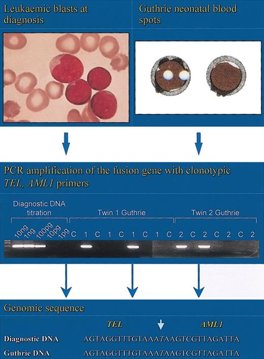 Figure 9. Detection of clonotypic genomic fusion sequences of TEL-AML1 in the neonatal blood spots (Guthrie cards) of twins.