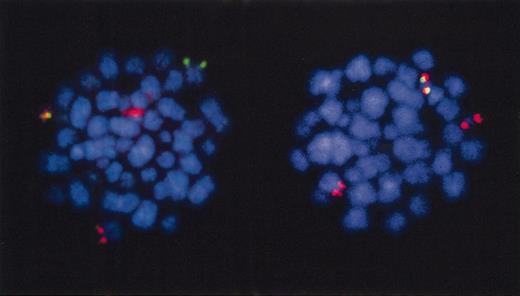 Figure 10. Fluorescence in situ hybridization to TEL and AML1 in leukemia from a twin patient. TEL deletion is subclonal. Red indicates AML1 probe; green, TEL probe. Metaphase cells have red plus green (=yellow), TEL-AML1 fusion signal. The cell on the left retains normal TEL allele (green signals). The cell on the right has lost normal TEL allele. Patient is twin in triplet set no. 16, data in Wiemels et al.68 FISH picture courtesy of Drs C Harrison and G Jalali (University of Southampton, United Kingdom).