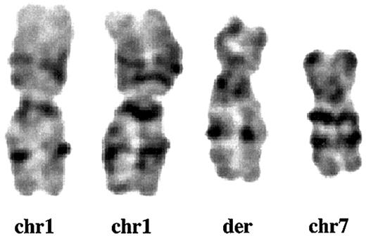 Figure 1. Partial karyotype of der (1;7)(q10;p10). GTG-banding analysis from Pt 1 shows that the whole long arm of chromosome 1 (chr1) and the whole short arm of chromosome 7 (chr7) fuse to constitute der(1;7)(q10;p10) (der).