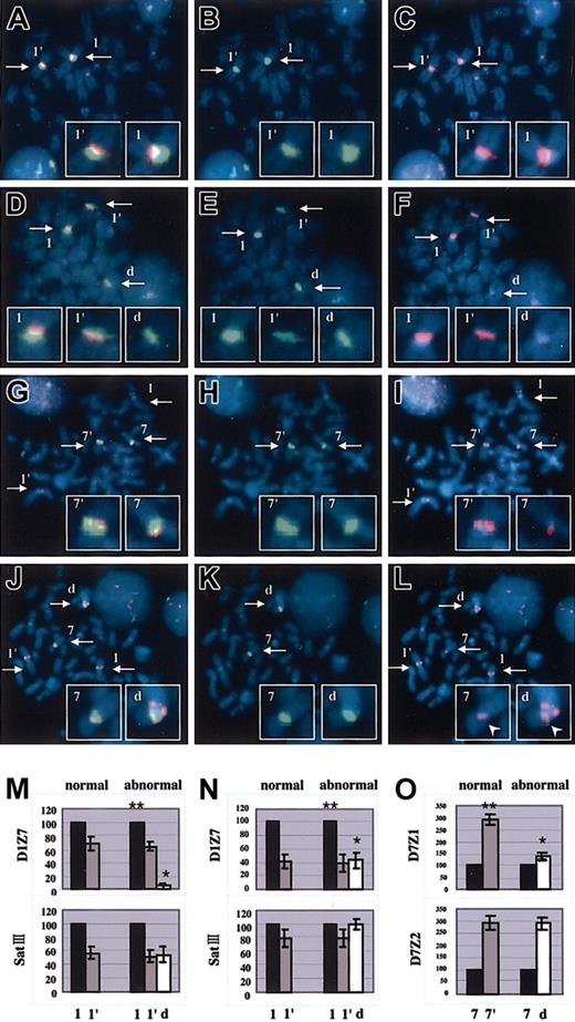 Figure 2. Representative results of 2-color FISH experiments and comparison of signal intensities in centromere alphoids. Two-color FISH was performed with SatIII (green) and D1Z7 (red) probes for normal (A-C) and abnormal (D-F) metaphases in Pt 6 and with D7Z2 (red), 97G24 (red), and D7Z1 (green) probes for normal (G-I) and abnormal (J-L) metaphases in Pt 16. 97G24 is a PAC probe located on 1q13 that helps detect trisomy of 1q. Images for FITC (B,E,H,K), Rhodamin (C,F,I,L), and both (A,D,G,J) were separately captured through a single triple-band-pass filter with an appropriate first-pass filter using a synchronized wheel filter device. 1 and 1′, 7 and 7′, and d indicate different alleles of chr1, chr7, and derivative chromosome, respectively. Captured images were subjected to measurement of signal intensities. Original magnification, × 1000. Intensity of the D1Z7 signal on derivative chromosome (*) is grossly reduced from its original intensity (**), as determined using SatIII intensity as a reference in Pt 6 (M) and Pt 8 (N). Likewise, D7Z1 signal on derivative chromosome (*) is also shown to decrease when compared with its original signal (**), as determined using D7Z2 intensity in Pt 16 (O). Arrows in panels A-L indicate the centromeres of chromosome 1, chromosome 7, or the derivative chromosome. Arrowheads in panel L point to the D7Z2 signals in order to distinguish these signals from the red signals of 97G24. Error bars represent the SD from 30 measurements in 1 patient.