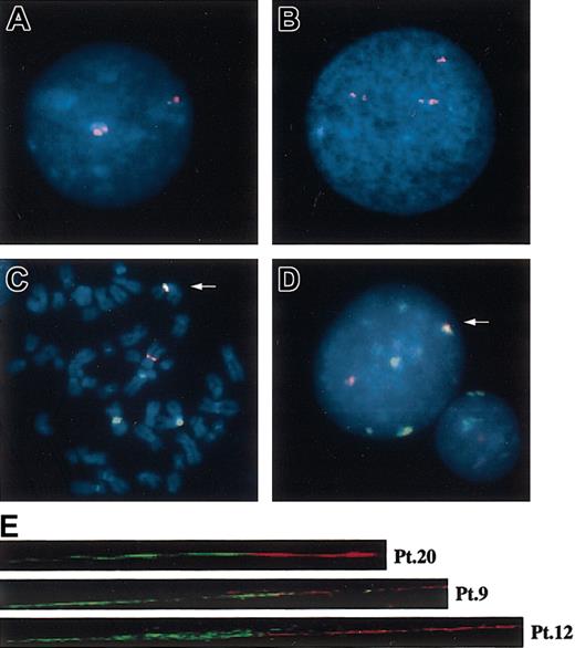 Figure 3. FISH analysis with the patients using various centromeric alphoid probes. Interphase FISH with a D1Z5 probe, CEP1, in normal (A) and abnormal (B) cells. Two-color FISH with pE25.a (green) and D7Z16mer (red) with tumor cells, showing almost completely overlapped signals (arrows) on metaphase (C) and interphase (D) nuclei. Original magnification, × 1000. (E) Fiber FISH analysis of der(1;7)(q10;p10) using a D1Z7 probe, CEP1/5 (red), and a D7Z1 probe, CEP7 (green), visualizing direct connection of both alphoids on the same DNA fiber.