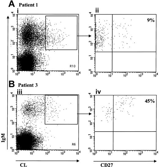 Figure 4. Phenotype of aCL IgM-bearing B cells. Representation of the 3 color FACS analysis on viable (PI-) lymphocytes after staining with labeled CL vesicles, anti-IgM and anti-CD27 of PBMCs from patient 1 (A) and patient 3 (B). IgM+/CL+ double-stained population is shown for patient 1 (Ai) and patient 3 (Biii). Panels Aii and Biv are gated on the double-stained population IgM+/CL+. The percentage of CD27+ cells is given.