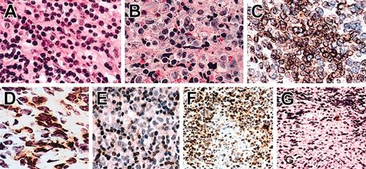 Figure 4. Hematoxylin and eosin (H/E) sections, immunohistochemistry, and in situ hybridization of NTENL. Representative examples of grade I (A) and grade III (B) nuclear morphologies. Note the smaller nuclei with condensed chromatin in panel A, and the larger nuclei with open chromatin in panel B. Not shown here, an intermediate morphology is grade II. By immunohistochemistry, an NK-NTENL was diffusely CD94+ (C) and focally NKG2A+ (D). Another NK-NTENL was CD3m-, with CD3m+ small T cells (E). In situ hybridization with the antisense cDNA probe demonstrated CD94+ lymphoma cells with focal necrosis (F); a corresponding area stained by the sense cDNA probe showed rare cells with nonspecific staining (G). All at magnification × 1000, H/E on paraffin sections (A-B), immunoperoxidase stains on frozen sections (C-D), or paraffin sections (E-G).
