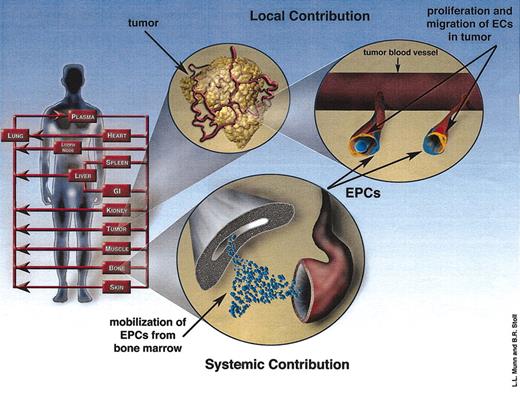 Figure 1. Model schematic illustrating the local and systemic contributions to angiogenesis. The human body is modeled as a series of organ compartments connected in an anatomic manner. The local contribution consists of the proliferation and migration of ECs (orange cells) in response to the local imbalance between angiogenesis stimulators and inhibitors. The angiogenesis stimulators produced by the tumor initiate the systemic pathway as well, which involves the mobilization of EPCs from the bone marrow. EPCs (blue cells) can localize in tumor vessels and contribute to angiogenesis.
