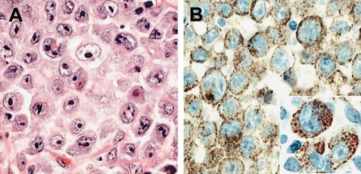 Figure 1. Morphology of ALK and DLBCL. (A) H&E-stained section of the diagnostic lymph node biopsy from case 1 showing neoplastic cells with immunoblastic and plasmablastic features. (B) The ALK-1 stain reveals fine granular cytoplasmic localization of the ALK protein (inset). Original magnifications: ×400 (A-B); ×800 (inset).