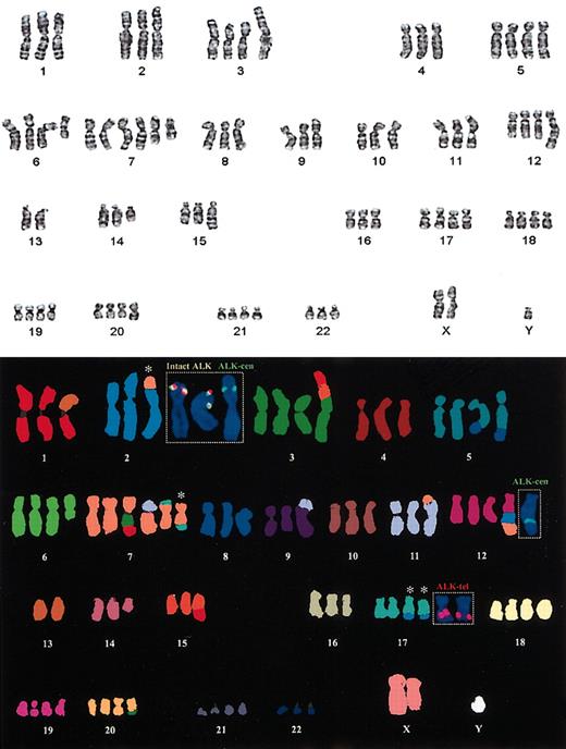 Figure 2. Standard cytogenetic analysis showing the complex karyotype from case 1 and M-FISH with dual-color FISH confirming the t(2;17;7)(p23;q23;q?22). The inserted locus-specific FISH images show the location of the multiple copies of the ALK gene. The colocalization of the green and red probes (yellow signal) is seen on the 2 copies of the normal chromosome 2. The centromeric ALK probe (green) is seen on the der(2) and on the derivative chromosome 12. The telomeric ALK probe (red) is localized to the 2 copies of the der(17). The white asterisks denote the chromosomes involved in the 3-way translocation. The combined G-band and M-FISH karyotype interpretation was as follows: 80, XXY, der(1)t(1;13)(q10;q10), t(2;17;7)(p23;q23; q22), del(3)(p25), +der(3)(3qter-> 3p21::15q11-> 15q21::1q25-> 1qter), der(5)t(5;8)(q33; q22), +der(5)t(5;8)(q33;q22),+del(6)(q?21),+der(7)(7pter-> 7q11::3?-> 3?::1q25::1qter), +der(7)t(7;11)(q11;p11),+der7t(7;17)(?;?),der9t(9;11)(p23;?q23),der11t(7;11)(p13;p14),+der12-(12pter-> 12q21::2p1?3-> p23::7q22-> 7qter), -13, del(14)(q?13q24), der(15)t(1;15)(q25; q22),+der(17)t(2;17;7)(p23;q23;q22), +18,+19,+der(20)t(3;20)(?p25;q12),+21.