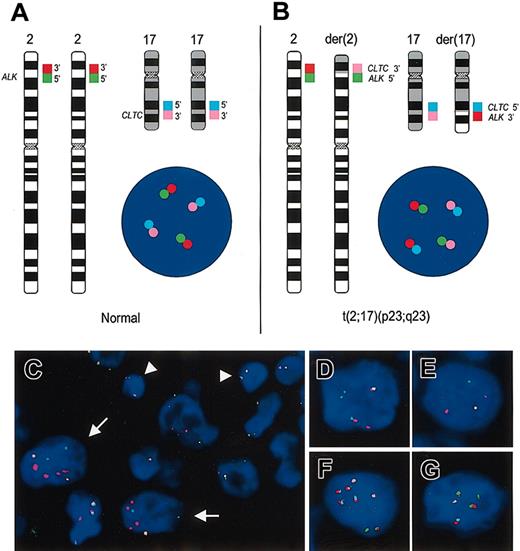 Figure 3. Dual and multicolor interphase FISH for the detection of breakpoints in the ALK and CLTC loci. (A) Ideograms of chromosomes 2 and 17 showing the ALK(2p23) and CLTC(17q23) flanking probes labeled with different dyes. The schematic interphase nucleus displays a FISH signal pattern indicating intact ALK and CLTC loci. (B) Scheme of chromosomes 2 and 17 containing the t(2;17)(p23;q23) reciprocal translocation as well as an interphase nucleus harboring this translocation. Derivative chromosomes 2 and 17 show a colocalization of green/pink and pale blue/red signals, respectively. The latter points to the CLTC-ALK fusion leading to activation of the ALK tyrosine kinase. (C) Interphase FISH in case 2 hybridized with the LSI ALK probe. Arrows point to tumor cells with isolated red and green signals indicating the presence of a breakpoint in the ALK locus. Arrowheads point to nontumoral cells containing the signal constellation for 2 intact ALK loci. (D-E) Interphase cells from case 3 (D) and case 4 (E) hybridized with the dual-color CLTC break-apart probe. Both cases show a split of the red and green signals pointing to a breakpoint in the CLTC locus. (F-G) False color display of interphase cells from case 2 (F) and case 1 (G) hybridized with the multicolor break-apart probe for ALK and CLTC (described in panels A-B). Both cells contain red/pale blue colocalizations, which indicate the fusion of the 5′-end of CLTC with the 3′-end of ALK leading to activation of the ALK tyrosine kinase. Besides, the presence of isolated green and pink signals indicates that the reciprocal 5′ALK-3′CLTC fusion is missing, probably due to complex chromosomal aberrations. The lack of an isolated red 3′ALK signal renders an additional fusion other than CLTC-ALK highly unlikely.