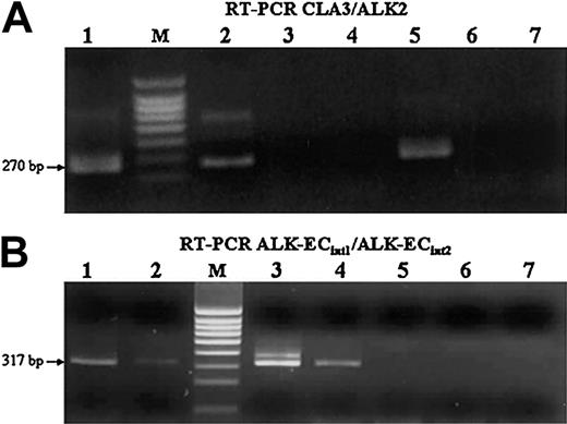 Figure 4. RT-PCR analysis of CLTC-ALK and ALK extracellular domain transcripts. (A) Cases 1 and 5 (lanes 1-2) and the NIH3T3 cell line transfected with CLTC-ALK cDNA, used as positive control (lane 5), show the expected 270-bp CLTC-ALK RT-PCR product (M indicates size marker). No band could be amplified from the Rh30 (lane 3), NIH3T3 cell line transfected with ALK-EC cDNA (lane 4), SU-DHL1 (lane 6), and COST (lane 7) cell lines, used as negative controls. (B) Transcripts encoding the extracellular portion of ALK also were present in the cases expressing CLTC-ALK transcripts (lanes 1-2), as in the Rh30 (lane 3) cell line and in the NIH3T3 cell line transfected with ALK-EC cDNA (lane 4), used as positive controls. As expected, no signal was present in either of the t(2;5)-positive SU-DHL1 (lane 6) and COST (lane 7) cell lines, nor in the NIH3T3 cell line transfected with CLTC-ALK cDNA (lane 5).