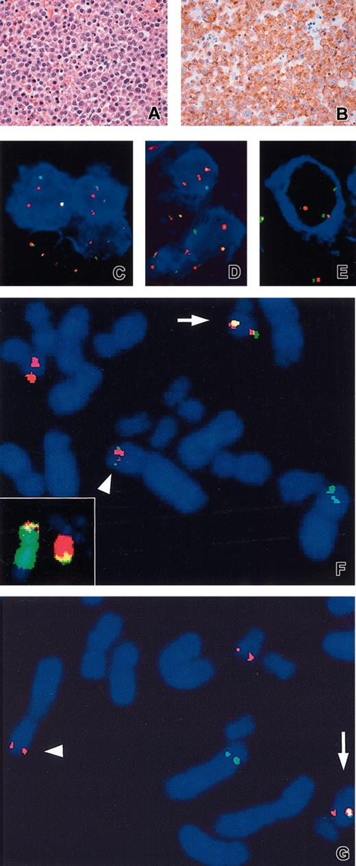 Figure 1. Histologic, immunophenotypic, and molecular cytogenetic findings. An example of hematoxylin and eosin (A) and ALK1 (B) staining performed in case 3 showing, respectively, a massive proliferation of plasmablast-like cells and a granular cytoplasmic localization of ALK. FICTION with LSI ALK and ALK1 (blue) (C), or anti-IgA (blue) (case 1) (D), and anti-IgG (case 2) (E). Metaphase FISH with ALK P1 (1111H1) (green) and BAC 758H9 (CLTC) (red) in case 1 (F) and case 2 (G). Arrowhead and arrow indicate the der(2) and der(17), respectively. Inset in panel F: WCP2 (green) and WCP17 (red). Note 1F2O1G FISH signals in case 1 (C-D) pointing the ALK gene rearrangement in ALK1+/IgA+ cells. Extra red signal possibly reflects an additional copy of the der(17) chromosome. Original magnifications: × 200 (A-B); × 630 (C-G).