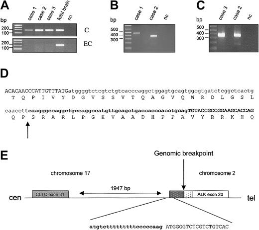 Figure 2. Identification and schematic representation of the CLTC-ALK fusion transcripts. (A) RT-PCR specific for the cytoplasmic (“C”) or the extracellular (“EC”) portion of ALK in cases 1 to 3 and in fetal brain cDNA (positive control); nc indicates negative control. (B) RT-PCR performed on cases 1 and 2 (relapsed) with primers for the CLTC-ALK fusion. (C) RT-PCR for case 3 with primers for CLTC-ALK; case 2 served as a positive control. (D) Sequence of the fusion transcript/fusion protein of case 1. Exon sequences are in uppercase, intron sequences are in lowercase, and ALK sequences are in bold. Arrow indicates the genomic junction. (E) Schematic representation of the breakpoint region on the der(17) chromosome. () CLTC intron sequence present in the fusion transcript. (▦) ALK intron sequence present in the transcript. Arrow indicates the chromosomal breakpoint.