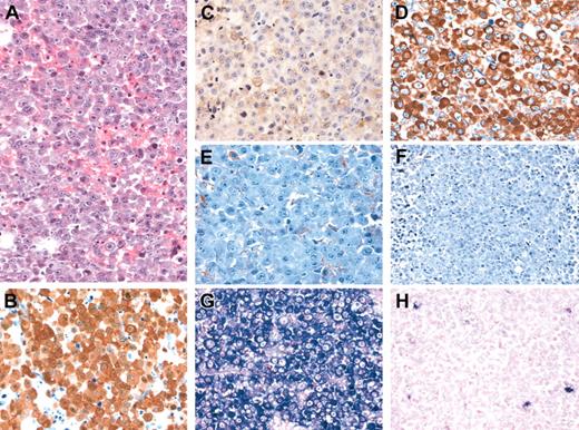 Figure 1. Morphologic and immunophenotypic features of ALK-positive large B-cell lymphoma. Characteristic plasmablastic and immunoblastic morphology (H&E staining) (A). On immunohistochemical staining (B-F), the tumor strongly expresses ALK, with a diffuse cytoplasmic and nuclear pattern (B), CD79, with a weak and focal membrane pattern (C), and cytoplasmic immunoglobulin (Ig) alpha heavy chains (D) and lacks expression of Ig gamma (E) and Ig mu (F) heavy chains. (Immunoperoxidase staining with hematoxylin counter-stain, panels B-F.) By in situ hybridization for immunoglobulin lambda (G) and kappa (H) light chain RNA the tumor shows lambda light chain restriction. Original magnification, × 400.