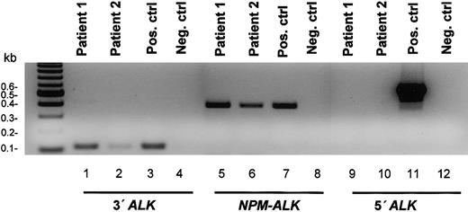 Figure 2. RT-PCR analysis demonstrating the presence of the NPM-ALK fusion transcript and the absence of mRNA for the extracellular portion of ALK in 2 cases of ALK-positive B-cell lymphoma. RT-PCR was performed on total RNA extracted from the patient tissue samples, a known positive control, and a known negative control. The presence of amplifiable RNA was confirmed by RT-PCR amplification of a 321-bp portion of the ubiquitously expressed NPM gene. The analysis demonstrates the presence of 429-bp NPM-ALK and 121-bp 3′ALK (encoding for the intracellular portion of ALK, also present in the NPM-ALK) transcripts and is negative for the 552-bp 5′ALK transcript (encoding for the extracellular portion of ALK).
