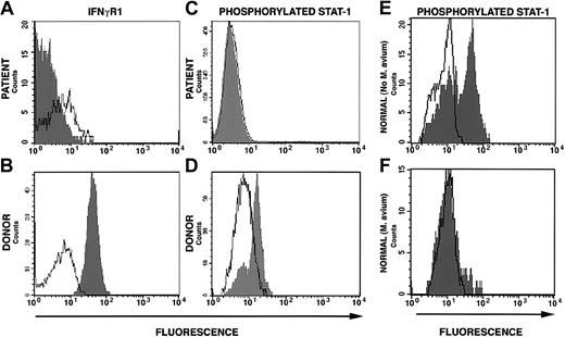 Figure 2. Surface interferon-γ receptor-1 expression and STAT1 phosphorylation. (A) Down-regulation of surface expression of IFNγR1 on mononuclear cells from the patient 322 days after allogeneic stem cell transplantation (160 days after complete donor stem cell engraftment). (B) Down-regulation of STAT1 phosphorylation following stimulation with IFNγ of cells from patient at the same time as in panel A. (C) Normal IFNγR1 expression on donor mononuclear cells and (D) normal STAT1 phosphorylation following IFNγ stimulation of donor cells. (E) STAT1 phosphorylation in response to IFNγ stimulation in normal cells cultured in the absence of M avium and (F) in the presence of M avium.