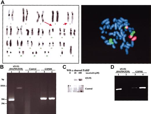 Figure 1. Identification of t(5;10) translocation with H4/PDGFβR fusion genes and induction of apoptosis by imatinib treatment. (A) Left panel: FISH using chromosome-specific painting probes to chromosome 5 (green) and chromosome 10 (red). Right panel: representative karyotype of a metaphase from bone marrow aspirate at diagnosis of disease. Arrows point to derivative chromosomes resulting from t(5;10)(q33;q22). (B) Amplification of the flanking region implicated in the translocation t(5;10) by nested RT-PCR with 2 sets of primers, set I (lanes 1,3) and set II (lanes 2,4). Total RNA from bone marrow collected from the t(5;10) patient (lanes 1-2) as well as from a Philadelphia-positive patient (lanes 3-4) was used as negative control. A450-bp region from the housekeeping gene G3PDH was also amplified from t(5;10) (lane 5) and control (lane 6) RNAs. (C) Bone marrow aspirate from patient and a control donor was cultured for 24 hours in the presence of the indicated amounts of imatinib. Cells were then lysed and submitted to Western blot analysis using anticleaved PARP (poly-adenosine diphosphate ribose polymerase) antibodies to determine the ratio of apoptosis. (D) Recession of H4/PDGFβR expression after therapeutic treatment with imatinib. Isolated RNAfrom peripheral blood before (lanes 1,3) and after (lanes 2,4) imatinib treatment was used in a nested RT-PCR analysis. The G3PDH gene (lanes 3-4) was used as an internal control to normalize the expression of H4/PDGFβR gene product (lanes 1-2). Intensity for each of the bands was quantified with a BioRad GelDoc2000 analyzer (Hercules, CA) and the ratio between them determined.