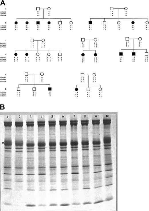 Figure 1. Exclusion of AE1 gene as cause of CDA-II. (A) Pedigrees of 7 families with CDA-II: haplotype analysis of 3 markers tightly linked to the SLC4A1 gene in 7 CDA-II families unlinked to CDAN2 locus on chromosome 20. White symbols indicate healthy subjects; black symbols, patients. (B) SDS-PAGE of red blood cell membrane proteins. SDS-PAGE was performed using the discontinuous buffer system of Laemmli with acrylamide linear gradient from 5% to 15%. The proteins were stained with Coomassie brilliant blue and gels were scanned using a laser densitometer (Ultroscan; Pharmacia, Uppsala, Sweden). The amount of the major membrane proteins was then expressed as the value of the relative surface area present under the densitometric curve, and the results were normalized to the protein 4.1. Erythrocyte membrane analysis of each patient and control was performed 3 times using different gels. The reproducibility of AE1 and protein 4.1 measurements was within a range of ± 4%. The amount of AE1 and protein 4.1 was compared with normal values obtained from controls. * indicates AE1; 1 and 10, controls; 2, HS due to AE1 deficiency; 3, 4, and 5, “typical” CDA-II; and 6, 7, 8, and 9, severe CDA-II.