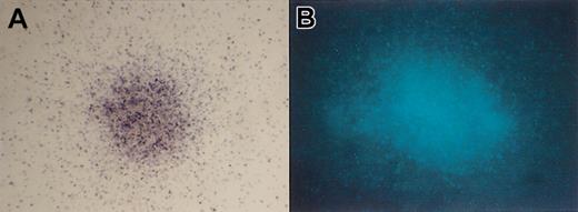 Figure 7. Photomicroscopic images demonstrating oxidase correction (NBT-positive staining in gp91phox–transduced X-CGD cells) and CFP transgene expression (fluorescence of CFP–transduced normal cells), panels A and B, respectively, in colonies derived from transduced CD34+ cells purified from chimeric mice. (A) NBT-positive colony from RD114-MFGSgp91phox–transduced X-CGD CD34+ PBSCs, 14 days after immunobead selection of human CD34+ cells from mouse bone marrow. Original magnification, × 60. NBT-negative colonies do not form formazan precipitate but can be delineated by safranin counter staining (not shown). (B) CFP-positive colony from RD114-MFGS-CFP–transduced normal CD34+ PBSCs, 14 days after immunobead selection of human CD34+ cells from mouse bone marrow. Original magnification, × 100.