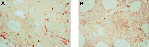 Figure 1. Change of MVD during therapy with SU5416 in a responding patient. Bone marrow histologies from the 74-year-old patient who was treated with SU5416 for 6 months taken prior to therapy (A) and after 8 weeks (B), showing a clear decrease in MVD under therapy. Endothelial cells were stained with an antibody against thrombomodulin (red). Original magnification, × 500.