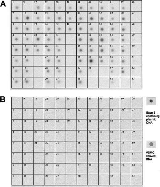 Figure 2. Expression of the SSH6 gene in a variety of human tissues and cell lines. Northern blot analysis of a commercially available human multiple-tissue expression array (MTE; Clontech). Hybridization with a probe corresponding to (A) exon 2-3-4 and (B) exon 3. Samples 1 to 61 correspond to poly A+ RNA from human tissues (1, whole brain; 2, cerebral cortex; 3, frontal lobe; 4, parietal lobe; 5, occipital lobe; 6, temporal lobe; 7, paracentral gyrus of cerebral cortex; 8, pons; 9, left cerebellum; 10, right cerebellum; 11, corpus callosum; 12, amygdala; 13, caudate nucleus; 14, hippocampus; 15, medulla oblongata; 16, putamen; 17, substantia nigra, 18, accumbens nucleus; 19, thalamus; 20, pituitary gland; 21, spinal cord; 22, heart; 23, aorta; 24, left atrium; 25, right atrium; 26, left ventricle; 27, right ventricle; 28, interventricular septum; 29, apex of the heart; 30, esophagus; 31, stomach; 32, duodenum; 33, jejunum; 34, ileum; 35 ilocecum; 36, appendix; 37, ascending colon; 38 transverse colon; 39, descending colon; 40, rectum; 41 kidney; 42, skeletal muscle; 43, spleen; 44, thymus; 45, peripheral blood leukocyte; 46, lymph node; 47, bone morrow; 48, trachea; 49, lung; 50, placenta; 51, bladder; 52, uterus; 53, prostate; 54, testis; 55, ovary; 56, liver; 57 pancreas; 58, adrenal gland; 59, thyroid gland; 60, salivary gland; 61, mammary gland); from human cell lines (62, leukemia HL-60; 63, HeLa S3; 64, leukemia, K-562; 65, leukemia MOLT-4; 66, Burkitt lymphoma Raji; 67, Burkitt lymphoma Daudi; 68, colorectal adenocarcinoma, A549); from fetal tissues (69, fetal brain; 70, fetal heart; 71, fetal kidney; 72, fetal liver; 73, fetal spleen; 74, fetal thymus; 75, fetal lung); and from controls (76, yeast total RNA; 77, yeast tRNA; 78, E coli rRNA; 79, E coli DNA; 80, Poly r(A); 81, human C0t-1 DNA; 82, 100 ng human DNA; 83, 500 ng human DNA). Panels at the right show the hybridization signal of the exon 3 probe with vascular SMC–derived RNA and exon 3 containing plasmid DNA, respectively.