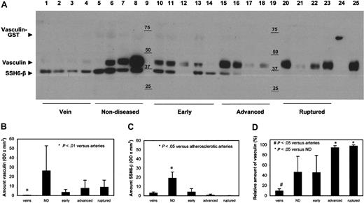 Figure 3. Vasculin and SSH6-β in the vascular wall. (A) Representative Western blot analysis of lysates of complete segments of veins, nondiseased arteries, and arteries displaying different stages of atherosclerosis (n = 2). Lanes 1 to 4, veins; lanes 5 to 8, nondiseased arteries; lanes 10 to 14, early atherosclerotic plaques; lanes 15 to 18, advanced atherosclerotic plaques; lanes 20 to 23, atherosclerotic plaques with a thrombus; lane 24 GST-vasculin; and lane 9 and 19, marker. For lysates and GST-vasculin, samples equivalent to 25 μg and 1 μg protein, respectively, were applied. (B-C) Quantitative data of vasculin and SSH6-β content, respectively, as judged by densitometric scanning of 2 independent Western blot analyses (mean ± SD, n = 4-5). ND indicates nondiseased. (D) Relative amount of vasculin versus the total amount of vasculin + SSH6-β, as determined in panels B-C, in veins and arteries displaying various stages of atherosclerosis (mean ± SD, n = 4-5). ND indicates nondiseased.