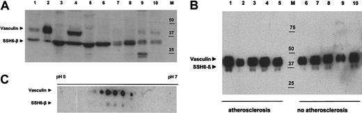 Figure 4. Western blot analysis of vasculin and SSH6-β. For each sample, amounts equivalent to 25 μg protein were applied. Vasculin and SSH6-β were detected by scFv-2A4 (5 μg/mL) and visualized using enhanced chemiluminescence. (A) Analysis of a variety of human cell lines and tissues. Lane 1 shows atherosclerotic plaque; lane 2, human plasma; lanes 3 to 6, human cell lines (3, colon carcinoma; 4, human umbilical vein endothelial cells; 5, Louis lung carcinoma; 6, vascular SMC line); lanes 7 to 11, human tissues (7, muscle; 8, brain; 9, ovary; 10, aorta); and M, marker. (B) Plasma samples from patients with (lane 1 to 5) or without (lane 6 to 10) clinical manifestations of renal atherosclerotic disease. M indicates marker. (C) A 2D gel electrophoresis analysis of a human atherosclerotic plaque lysate. Advanced plaque lysate (50 μg) was separated using a 7-cm pH gradient strip (pH 4-7) and a 12% SDS-PAGE and transferred onto nitrocellulose.
