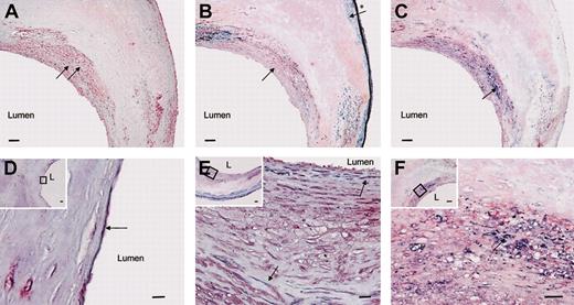 Figure 5. Localization of vasculin and SSH6-β protein in the vascular wall. Cross-sections of an atherosclerotic plaque stained by immunohistochemistry. (A) Vasculin and/or SSH6-β is visualized in red (black arrows). (B,E) Combined immunohistochemical staining for vasculin and/or SSH6-β (red) and anti–smooth muscle actin demonstrating SMC (blue). Pronounced vasculin/SSH6-β signals are observed in neointimal SMC (black arrow), whereas vasculin/SSH6-β signals are minimal in medial SMCs (arrow with *). (C,F) Combined immunohistochemical staining of vasculin and/or SSH6-β with anti-CD68 (blue) demonstrates the presence of SSH6 gene products in monocytes/macrophages, as indicated by a black arrow. (D) Combined immunohistochemical staining of vasculin and/or SSH6-β with anti-CD31 (blue) shows vasculin/SSH6-β in endothelial cells. The black arrow indicates an endothelial cell expressing vasculin/SSH6-β. (D-F) Insets represent overview pictures with regions in D-F outlined by a ⋄. L indicates the lumen. Bars in panels A-C and the insets in D-F represent 100 μm; bars in D-F represent 10 μm.