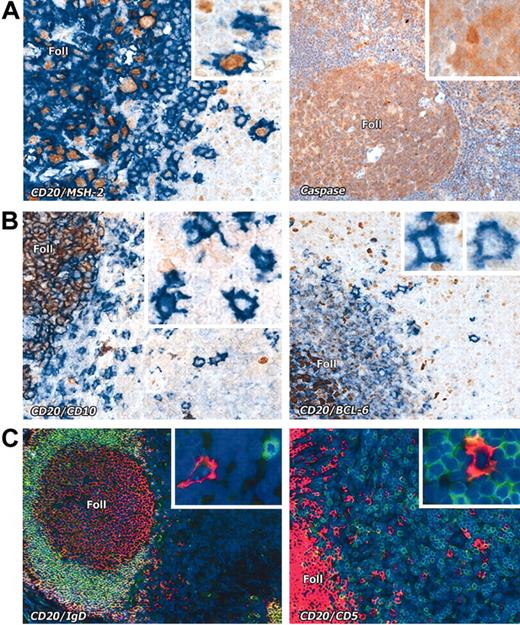 Figure 3. Interfollicular large B cells stained with various markers. (A) Left panel: Nuclear expression (brown) of the mismatch repair enzyme MSH2 is seen in CD20+ (blue) interfollicular large B cells (seen at higher magnification in the inset). Right panel: Interfollicular large B cells express caspase-3 (brown); inset shows a caspase-3+ interfollicular large B cell at higher magnification. (B) The germinal center–associated markers CD10 (brown) and BCL-6 (brown) are absent from CD20+ (blue) interfollicular large B cells. Insets show the staining pattern of the interfollicular large B cells at higher magnification. Note expression of these markers in cells within lymphoid follicles (Foll). (C) Interfollicular large B cells do not express IgD or CD5 (double immunofluorescence labeling, with CD20 in red and the other markers in green, as also shown at higher magnification in the insets). Magnification is × 20 for all main images and × 40 for the insets.