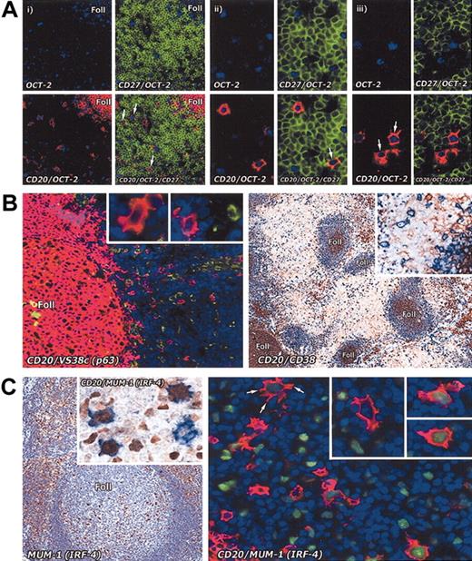 Figure 4. Immunostaining of interfollicular large B cells for memory and plasma cell markers. (A) Staining for memory markers. The memory cell marker CD27 analyzed on interfollicular large B cells in the tonsil by combining immunoenzymatic (OCT-2 blue) and double immunofluorescence staining (CD27 green; CD20 red). (i) Low-power view (paraffin section; magnification, × 20) shows that interfollicular large B cells are OCT-2+ and CD20+, but are CD27– (arrows). In contrast, T cells (green) are strongly CD27+. (ii) Two OCT-2+ and CD20+ interfollicular large B cells in the same section are shown at higher magnification (× 40): one of them (arrow) appears to be weakly CD27+. (iii) Two OCT-2+ and CD20+ (arrows) interfollicular large B cells in a frozen tissue section are clearly CD27–. Magnification, × 40. (B) The plasma cell–associated markers p63 (antibody VS38c) (as also shown at higher magnification in the insets) and CD38 are not expressed by interfollicular large B cells. Left panel: double immunofluorescence staining (CD20 red; VS38c green). Magnification, × 20. Right panel: double immunoenzymatic staining (CD20 blue; CD38 brown). Magnification, × 10. (C) In contrast, MUM-1 (IRF-4), a transcription factor found in many plasma cells and in scattered cells in the light zone of germinal centers, is seen in some interfollicular large B cells (left panel; magnification, × 20). Double immunoenzymatic staining (left panel, inset) shows 3 out of 4 cells coexpressing CD20 (blue) and MUM-1 (brown). Magnification, × 40. On the right, double immunofluorescence labeling (CD20 red; MUM-1 green) of an interfollicular area confirms that a proportion of CD20+ cells coexpress MUM-1 (as also shown at higher magnification in the insets). Note the markedly dendritic profile of the arrowed cell. Magnification is × 40 for all insets.
