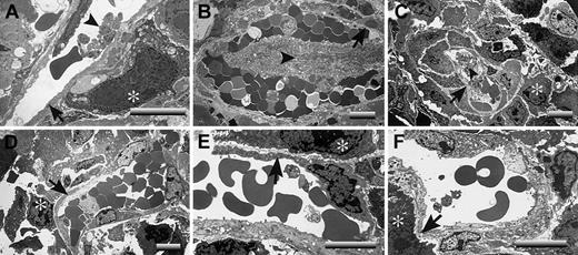 Figure 5. Occlusive microvascular thrombi are prominent in LLC footpad tumors derived from plasminogen-deficient mice. Electron microscopic evaluation of footpad tumor vasculature revealed widespread microvascular thrombi within tumors derived from Plg– mice (A-C) but not tumors collected from control (D), Fib– (E), or Plg–/Fib– (F) animals 14 days after initial tumor cell transplantation. These representative sections from Plg– mice include examples of vessels with small platelet aggregates (A) and vessels with advanced, highly occlusive thrombi (B-C). Occlusive platelet thrombi (arrowheads) were found in areas populated with viable tumor cells (*) and where the endothelium appeared essentially intact (arrows). Note that occlusive intravascular thrombi were not a feature of the rapidly growing tumors of control mice and Fib– mice. More significantly, no such platelet aggregates were observed in plasminogen-deficient mice lacking fibrinogen (F), animals that exhibited no impediment in tumor growth. Horizontal bars in each micrograph indicate 8 μm.
