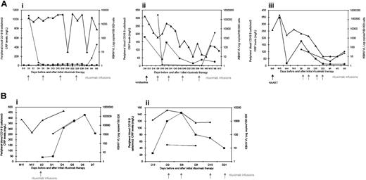 Figure 1. Longitudinal evolution of KSHV DNA copies in PBMCs, serum CRP, and peripheral blood CD19 B-cell counts in patients infected with HIV-1 with multicentric Castleman disease before and after treatment with 4 weekly infusions of rituximab. (A) Responders include patients 1 (i), 4 (ii), and 5 (iii) with complete remissions with no clinical symptoms with a follow-up of 3 to 12 months. (B) Nonresponders include patients 2 (i) and 3 (ii) without any response to rituximab. VL indicates viral load; D, day; W, week; and M, month. ▪ indicates CRP; ♦, CD19; and ▴, KSHV VL.