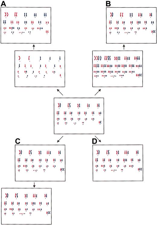 Figure 2. Four possible mechanisms for the formation of hyperdiploidy. (A) Doubling of a near-haploid set of chromosomes, resulting in widespread LOH caused by UPD. (B) Initial polyploidization with subsequent losses of chromosomes, resulting in LOH for approximately one third of the disomic chromosomes and equal allele dosages for tetrasomic chromosomes. (C) Sequential gains of individual chromosomes in consecutive cell divisions, resulting in unequal allele dosages for two thirds of the tetrasomic chromosomes. (D) Simultaneous gain of chromosomes in a single abnormal mitosis, resulting in equal allele dosages for tetrasomic chromosomes.