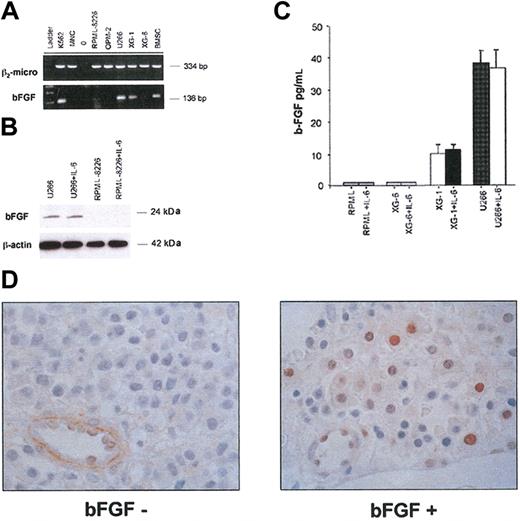 Figure 1. bFGF expression by HMCLs and by MM patients. RT-PCR was performed in order to test bFGF mRNA expression in HMCLs (RPMI-8226, OPM-2, U266, XG-1, and XG-6) and bone marrow stromal cells (BMSCs) obtained from patients with MM. β2-microglobulin was amplified as internal control. K562 and mononuclear cells (MNCs) from healthy subjects were used as positive and negative control, respectively (A). HMCLs (106/mL) were incubated in the presence or absence of IL-6 (20 ng/mL). bFGF protein was assessed either in cell lysates by Western blot analysis after 24 hours (B) or in conditioned medium by ELISA after 48 hours (C). (D) bFGF immunostaining in BM biopsies of 2 representative patients with MM with negative (left) and positive (right) myeloma cells performed with anti-bFGF polyclonal Ab (25 μg/mL) using indirect immunoperoxidase detection method.6,7 Endothelial cells are the internal positive control. Original magnification, × 100.