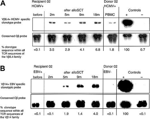 Figure 1. Following HCMV D+/R+, EBV D-/R+ alloSCT, an immunodominant HCMV-specific donor CD8+ T-cell clone expanded and persisted in recipient 02, and a primary EBV-specific CD8+ T-cell response developed within 5 months. (A) Clonotypic probing was used to quantify the donor CD8+ T-cell clone specific for HCMV pp65417-426 (clone 2.1) in sequential peripheral blood samples taken from recipient 02 before and after alloSCT. The clone was not detected in recipient 02 prior to transplantation but was detectable at all time points tested following alloSCT. All blood tests for HCMV DNAemia (performed weekly until 5 months after alloSCT) were negative. Because of renal dysfunction cyclosporin was discontinued at 3 months. (B) In the same EBV-seropositive recipient 02, an EBV EBNA3C880-891 CD8+ T-cell clone (clone 2.3) was not present in the donor but following alloSCT was detected in the recipient from 5 months onward.