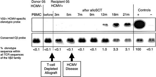 Figure 3. Following T-cell-depleted D-/R+ alloSCT, a primary HCMV-specific CD8+ T-cell response developed in recipient 05 within 12 months. An HCMV pp65495-503-specific CD8+ T-cell clone (clone 5.2) was obtained from the HCMV-seropositive recipient at 21 months after T-cell-depleted alloSCT. The clone was not detected in the donor or in recipient 05 prior to transplantation. Following an episode of HCMV retinitis at 5 months, the clone was first detected in recipient 05 at 12 months after alloSCT. The retinitis resolved following ganciclovir therapy, and subsequent weekly blood tests for HCMV DNA were negative.
