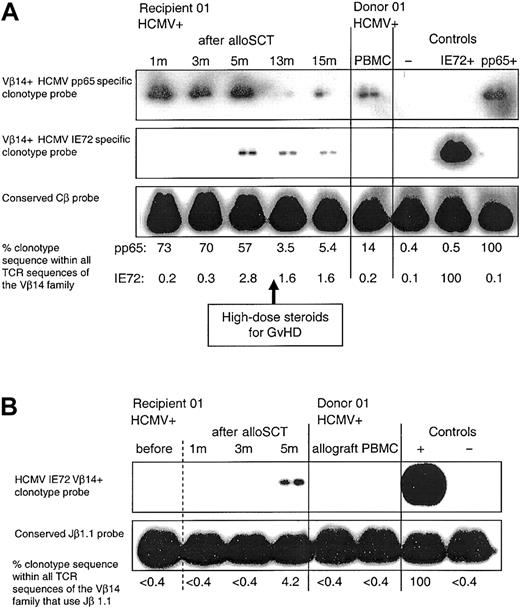 Figure 4. Following D+/R+ alloSCT there is delayed emergence of an HCMV-specific CD8+ T-cell clone that was not detectable in the donor. (A) The CD8+ T-cell clone generated in donor 01, which was specific for HCMV pp65495-503 (clone 1.1), was detectable in recipient 01 PBMCs at all time points tested following alloSCT. An HCMV IE72198-207-specific CD8+ T-cell clone (clone 1.4) was obtained from recipient 01 at 13 months after alloSCT; this clone was not detected in the donor or in the recipient at 1 and 3 months after alloSCT but was first detected at 5 months following transplantation. In the controls, the pp65+and IE72+-labeled lanes refer to the positive control cDNA used from clones 1.1 and 1.4, respectively. Weekly blood tests for HCMV DNA performed until cessation of immunosuppression at 15 months were negative. (B) PBMC samples in the same donor-recipient pair were amplified by seminested PCR as described. Clone 1.4 was not detectable in donor PBMCs or allograft, or in recipient samples taken prior to transplantation or at 1 and 3 months after alloSCT but was detected at 5 months.