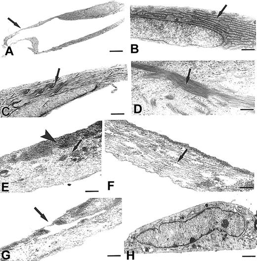 Figure 7. Utrastructural features of MMECs and a HUVEC. (A-G) MMECs. (H) HUVEC. (A,G) Two MMECs showing very thin cytoplasmic regions arranged in the form of a tubelike structure (arrows). (B) Another cell showing numerous and parallel arranged cisternae of rough endoplasmic reticulum (arrow). (C-F) Cells showing bundles of thickened microfilaments, located to nucleus (C-D, arrows) or to subcortical plasma membranes (E, arrowhead), or scattered in the cytoplasm (E, arrow), or showing disarranged microtubules (F, arrow). (H) A HUVEC showing lipid droplets and a normal distribution of cytoskeleton organelles. Scale bar, 2.7 μm (A); 0.4 μm (B); 0.8 μm (C); 0.2 μm (D); 0.4 μm (E-F); 0.3 μm (G); and 0.7 μm (H).