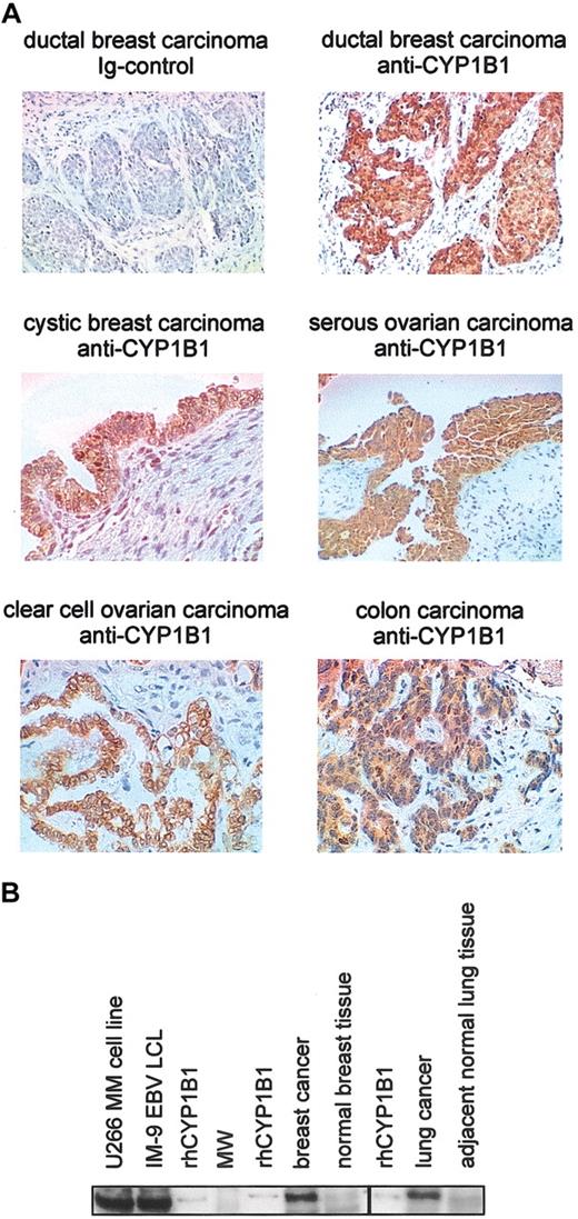 Figure 1. Expression of CYP1B1 protein in healthy and malignant tissue. (A) Expression of CYP1B1 in human tumors detected by immunohistochemistry using a polyclonal antibody. All tissues were also stained with an immunoglobulin control (upper left panel and data not shown). (B) Western blot analysis of microsomal fractions (30 μg per sample) from healthy and malignant tissue using the monoclonal CYP1B1 antibody (similar results were obtained using the polyclonal antibody). Healthy and malignant lung tissue samples were from the same patient; healthy and malignant breast tissue samples were from 2 persons. As a positive control, 0.015 pmol rhCYP1B1 was loaded.