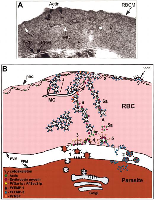 Figure 7. Proposed scheme for the transport of parasite proteins to the erythrocyte plasma membrane. (A) Many of the individual events depicted in Figures 1 to 5 are captured in a single (∼ 70 nm) section from an IRBC treated with AlF. Coated vesicles budding from the PVM form a vesicle chain that spans the RBC cytosol and associates with one end of a Maurer cleft. A vesicle in line with the (left-hand side) of a Maurer cleft is observed at the RBC membrane (white arrow). The Maurer cleft is anchored to the RBC plasma membrane via actin. Original magnification, × 20 000. (B) Schematic representation of the transport of Pf EMP1 and Pf EMP3 (and other parasite proteins) to the RBC cytosol and plasma membrane. Steps 1 and 2 are hypothetical pathways. Pf Sec31, Pf Sar1p, and possibly Pf Sec23p (which is in the Pf genome but is uncharacterized) are exported to the RBC cytosol in which they form Pf COPII, facilitating vesicle formation at the PVM (steps 3-5). Vesicle budding and transport may be actin-myosin-mediated processes (step 5, 5a). Vesicles containing Pf EMP1 and Pf EMP3 uncoat (step 5) and are transported across the RBC cytosol to the Maurer clefts (step 6) or directly to the erythrocyte plasma membrane (step 6a) by an actin-myosin-mediated process. Pf NSF associates with the vesicles prior to their interaction with the clefts or the erythrocyte plasma membrane. Vesicles could be transported along actin-tethered Maurer clefts to the RBC membrane (step 7), or vesicles could bud from the ends of the Maurer cleft and diffuse to the RBC membrane. The vesicles associate with the RBC cytoskeleton (step 8) leading to knob formation.9 The appearance of extended chains of vesicles in the RBC cytosol and at the RBC membrane in IRBCs treated with AlF suggests an AlF-sensitive factor (eg, small GTPases such as Pfsar1p and/or Pf Rabs) may prevent vesicle uncoating (step 5) and block vesicle fusion at the clefts and/or erythrocyte plasma membrane, respectively, causing the vesicles to backup into chains.