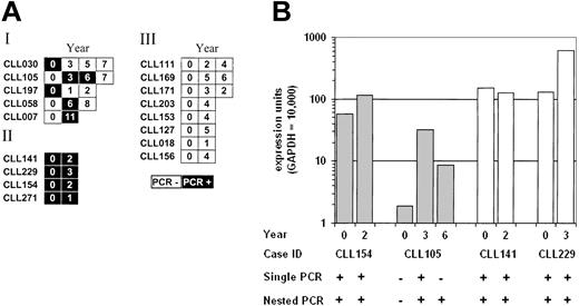 Figure 3. AID expression can change over time in some B-CLL cases. (A) Schematic representation of the AID RT-PCR results on 17 B-CLL cases at different time points. AID amplification was performed by using the primers 63F and 415R for 33 cycles. The open boxes represent PCRs without a detectable product; the filled boxes are a detectable product. The numbers in the boxes correspond to the number of years counted from the first tested sample date. (B) Real-time quantitative PCR results on B-CLL cases at different time points. The labeling of the graph and PCR conditions are as for Figure 2.