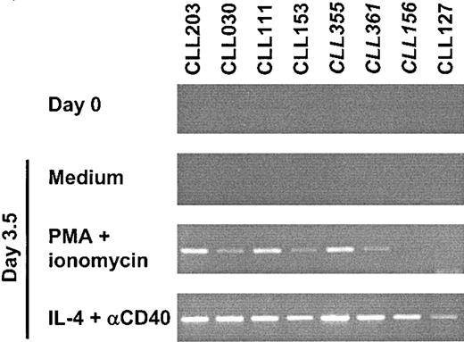 Figure 5. B-CLL can up-regulate AID on appropriate stimulation in vitro. RT-PCR results from purified B cells from 8 B-CLL samples, 5 mutated and 3 unmutated (italicized). RNA was extracted from purified B-CLL cases before (day 0, first panel from the top) and after 3.5 days of stimulation with either PMA and ionomycin (third panel) or CD32-transfected L cells with anti-CD40 mAb and IL-4 (fourth panel). Cells cultured in medium alone (second panel) or with only CD32-transfected L cells (not shown) remained RT-PCR negative throughout the culture period. AID amplification was performed using the primers 63F and 415R for 33 cycles. β-actin was positive and qualitatively similar in intensity for all tested samples (data not shown).