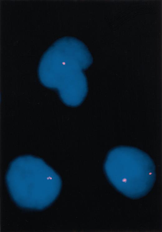 Figure 2. Fluorescence in situ hybridization (FISH) results. Three interphase cells from case 2, with 1 cell (bottom right) showing 2 CHIC2 signals (normal pattern) and 2 cells (top and bottom left) showing deletion of 1 CHIC2 signal (abnormal). Original magnification, × 1000.