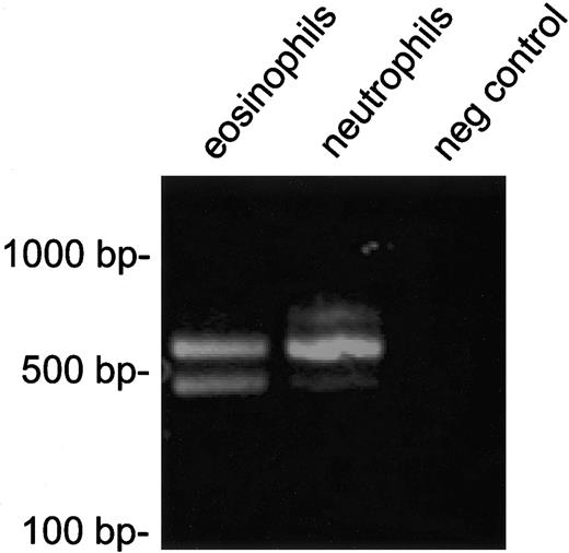 Figure 3. RT-PCR analysis of FIP1L1-PDGFRA expression in cell fractions enriched for eosinophils or neutrophils. FIP1L1-PDGFRA fusion transcripts were detected in both eosinophils and neutrophils. PCR products of different sizes are observed, due to alternative splicing in FIP1L1, as observed previously.10,23 Two alternatively spliced transcripts with the same intensity were detected in eosinophils, whereas 1 predominant splice variant is present in neutrophils.