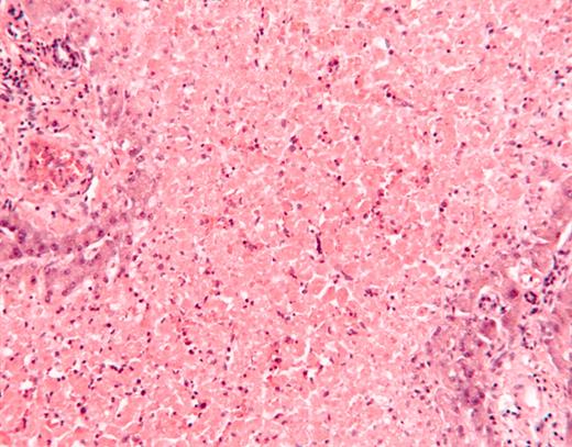Figure 1. Histologic section of liver, stained with hematoxylin and eosin, showing coagulative necrosis of hepatic parenchyma with focal viable hepatocytes in a periportal distribution. Original magnification × 200.