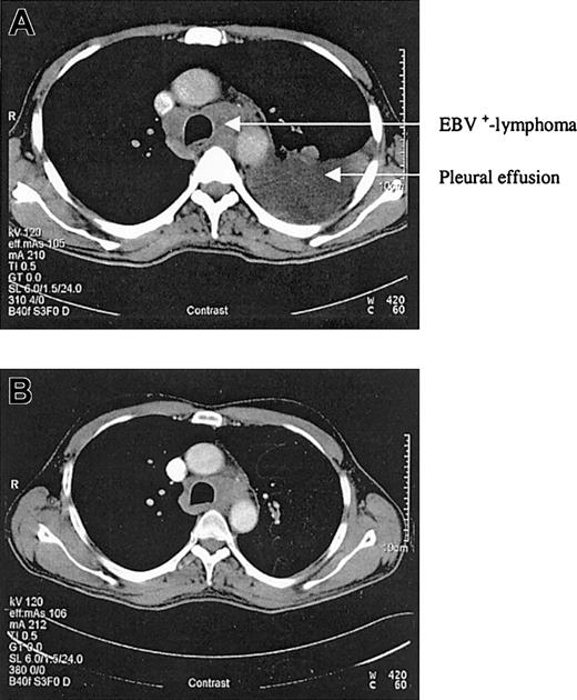 Figure 1. CT scans before and after rituximab application. (A) CT scan of the chest in April 2003. (B) Control CT scan after 4 applications of rituximab showing a good partial response.