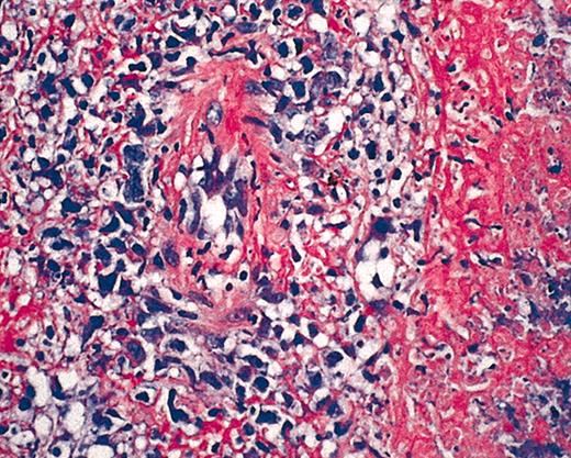 Figure 2. Hematoxylin and eosin (HE) staining of EBV+ B-cell diffuse large-cell lymphoma. Original magnification × 40.